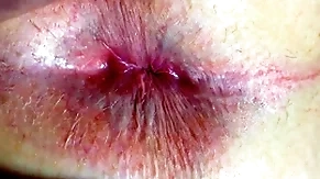 Irritant and anus closeup